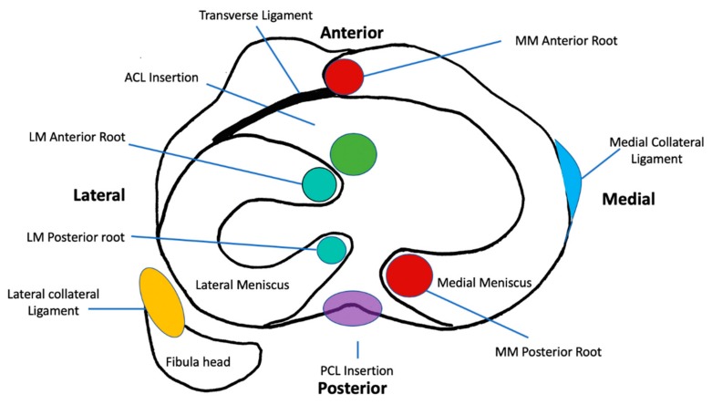 圖1:脛骨平臺水平的軸向截面示意圖,描繪了半月板的解剖結構、附件和關系 圖1:脛骨平臺水平的軸向截面示意圖,描繪了半月板的解剖結構、附件和關系