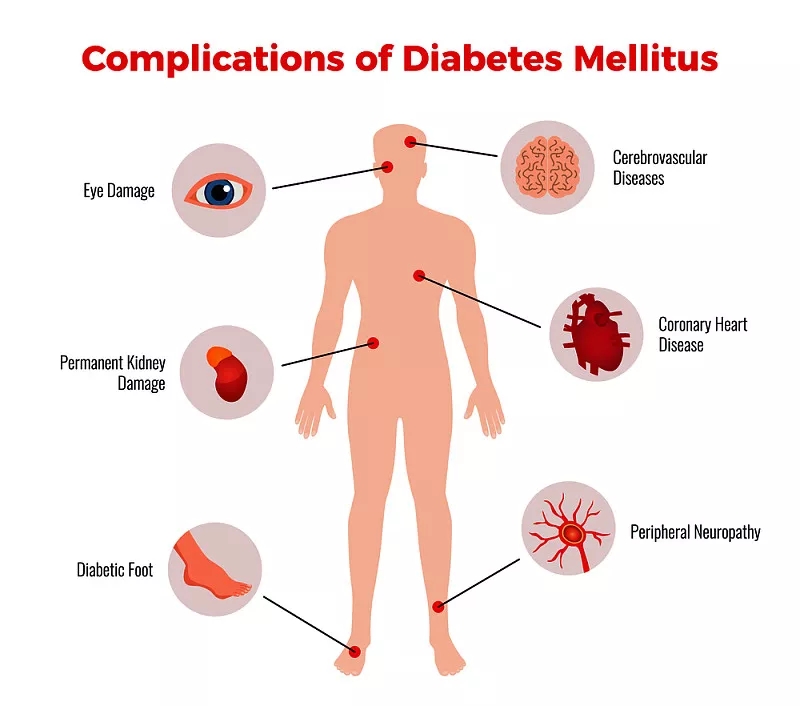 間充質干細胞在治療糖尿病及并發(fā)癥的臨床應用潛力 間充質干細胞在治療糖尿病及并發(fā)癥的臨床應用潛力