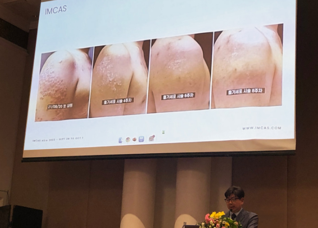 韓國Miracell在國際美容整形外科宣布用干細胞療法治愈銀屑病 韓國Miracell在國際美容整形外科宣布用干細胞療法治愈銀屑病