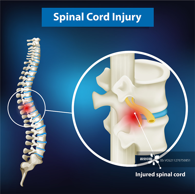 間充質(zhì)干細(xì)胞治療脊髓損傷的臨床應(yīng)用 間充質(zhì)干細(xì)胞治療脊髓損傷的臨床應(yīng)用