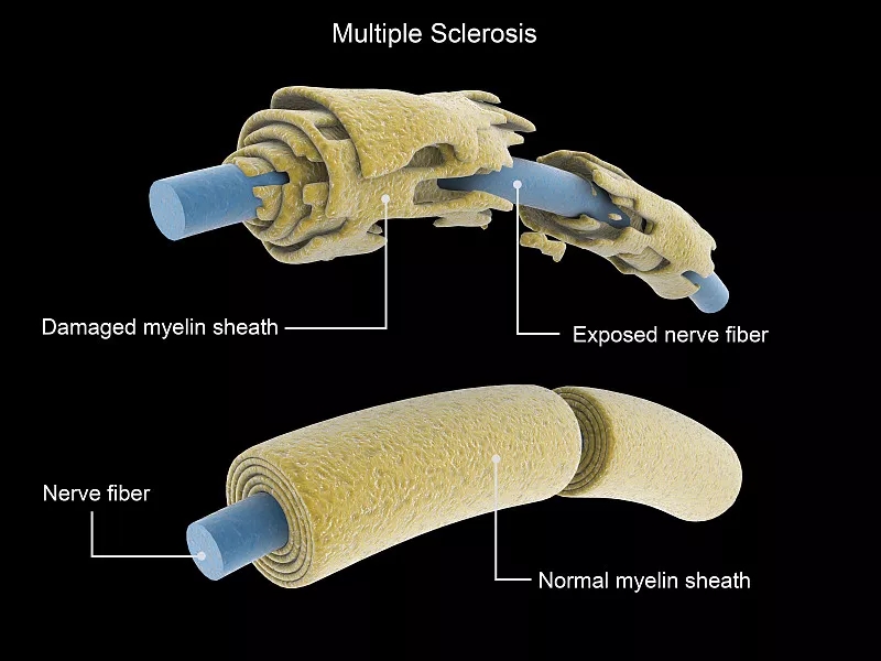 多發性硬化癥神經元與正常神經元的比較 多發性硬化癥神經元與正常神經元的比較
