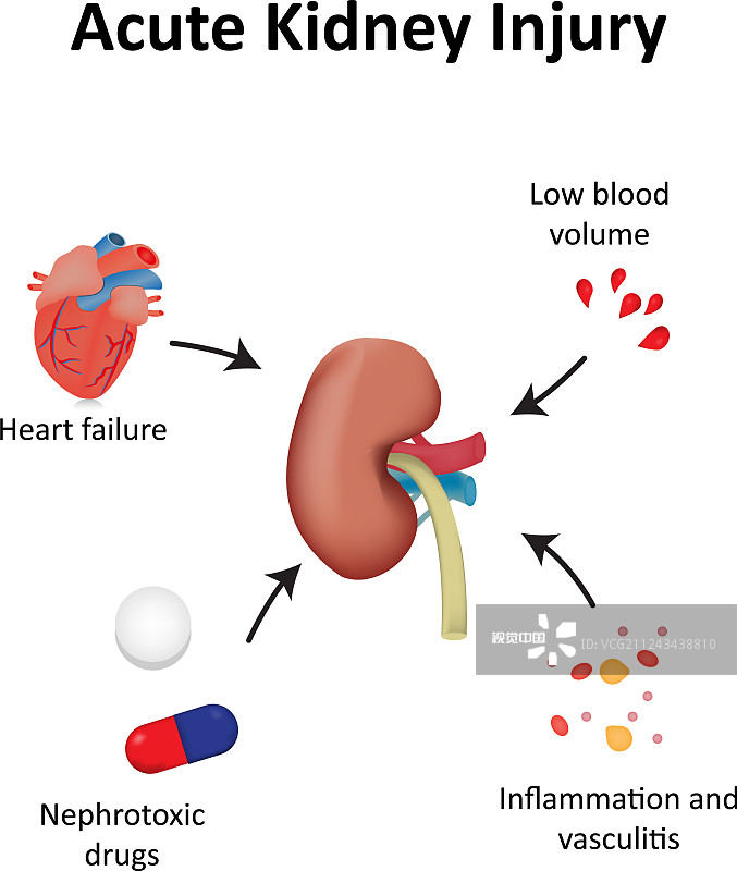 間充質干細胞治療急性腎損傷的臨床研究進展 間充質干細胞治療急性腎損傷的臨床研究進展