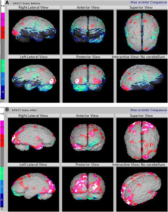 圖3:腦癱患者的 SPECT 掃描 圖3:腦癱患者的 SPECT 掃描