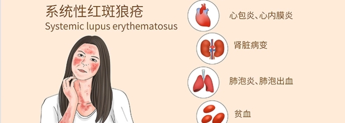 系統性紅斑狼瘡 系統性紅斑狼瘡