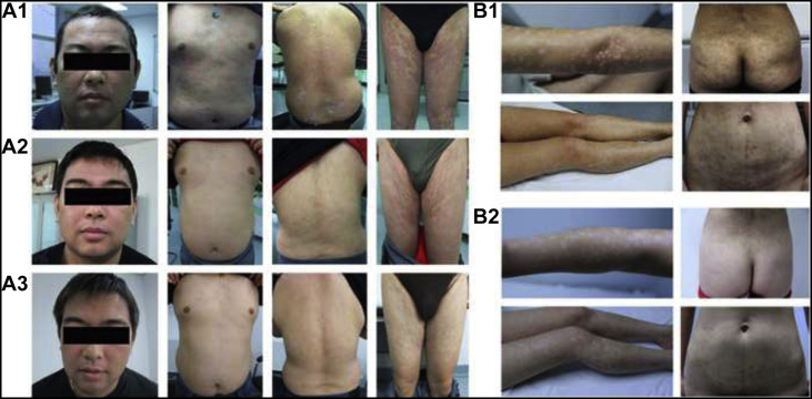 間充質干細胞治療銀屑病的臨床案例 間充質干細胞治療銀屑病的臨床案例