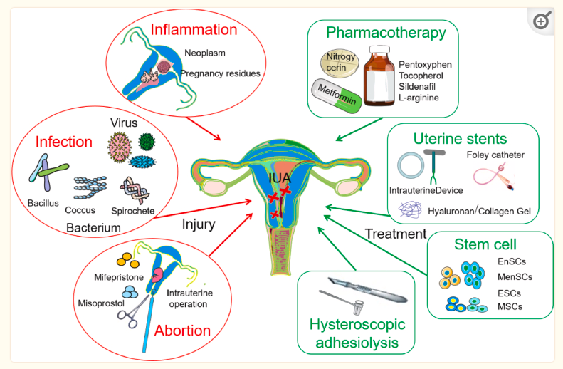 圖1:子宮內膜損傷的機制及主要治療策略。 圖1:子宮內膜損傷的機制及主要治療策略。
