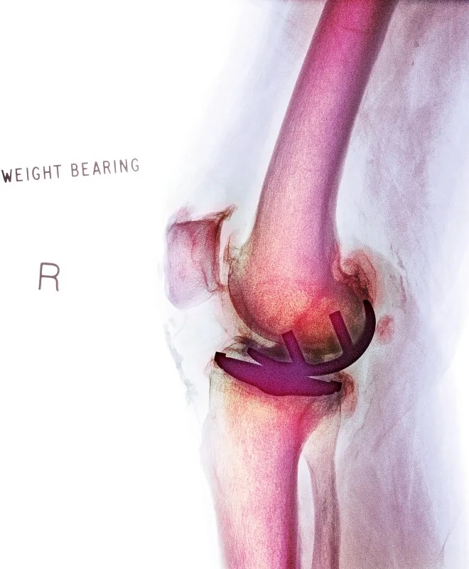 關(guān)節(jié)內(nèi)移植干細胞治療膝骨關(guān)節(jié)炎:一項IIb期臨床試驗