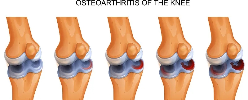 干細(xì)胞修復(fù)撕裂的無血管半月板軟骨:從體外優(yōu)化到首次人體研究