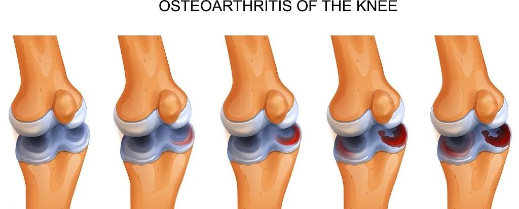 國內(nèi)外臨床研究表明:干細胞修復半月板損傷更具優(yōu)勢
