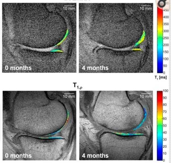 干細胞療法修復后疼痛顯著減輕,半月板軟骨質(zhì)量提高。