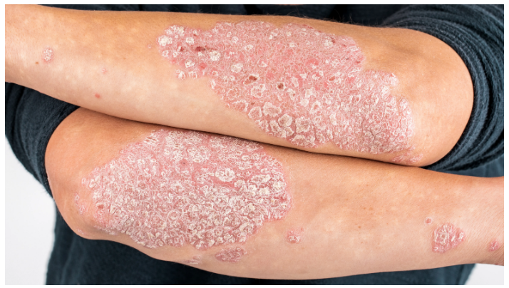 銀屑病概述-銀屑病癥狀-治療方法有哪些 銀屑病概述-銀屑病癥狀-治療方法有哪些