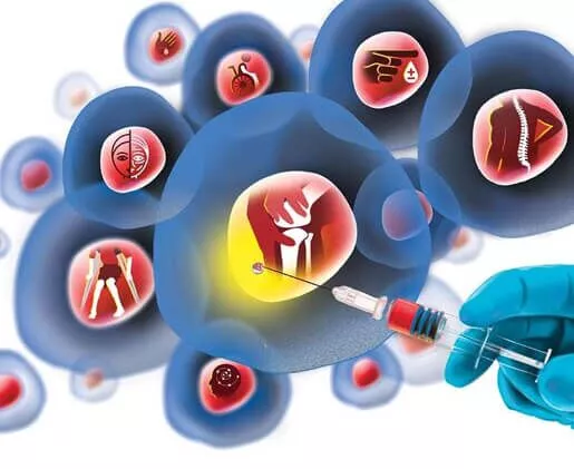 干細(xì)胞治療脊髓損傷的程序是什么 干細(xì)胞治療脊髓損傷的程序是什么