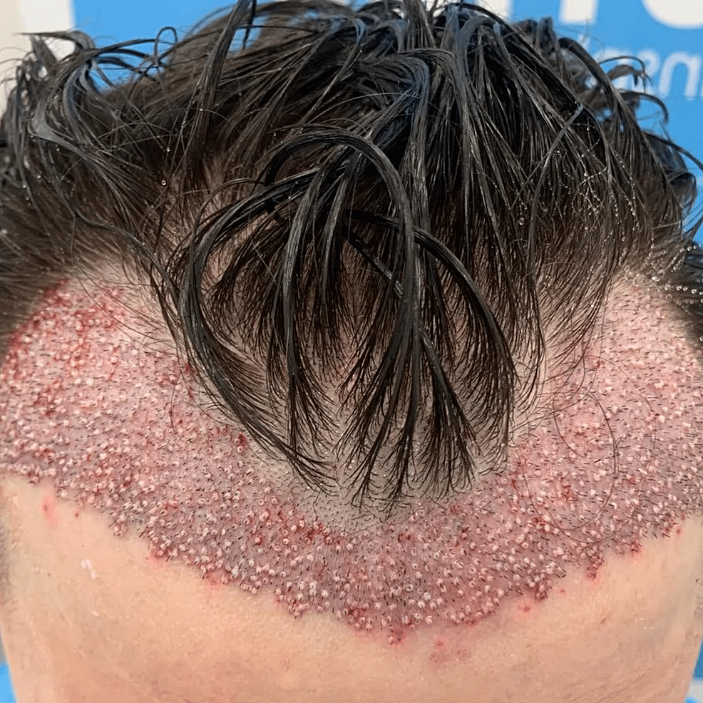 頭發移植手術后即刻的結果。——這允許在患者中建立更豐滿和更前的發際線 頭發移植手術后即刻的結果。——這允許在患者中建立更豐滿和更前的發際線