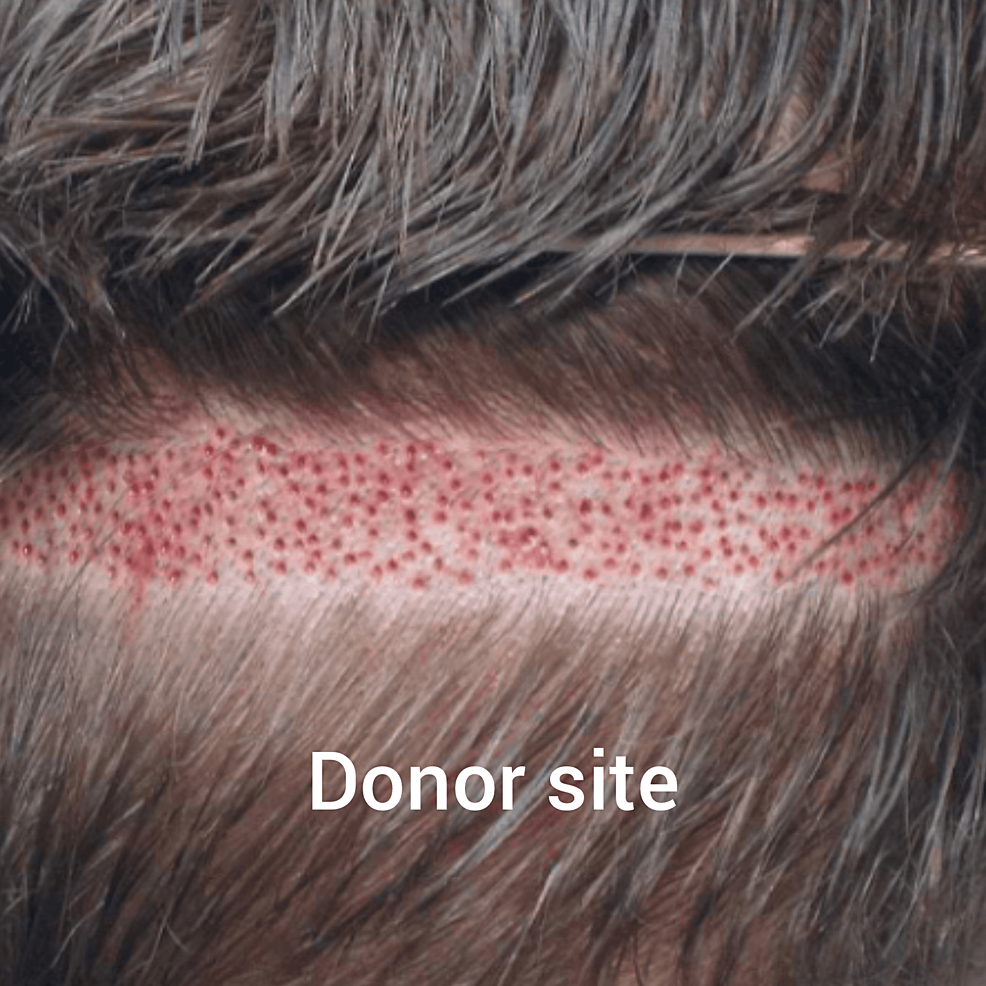 新技術的供體現場收獲試圖減少后部頭皮疤痕 新技術的供體現場收獲試圖減少后部頭皮疤痕