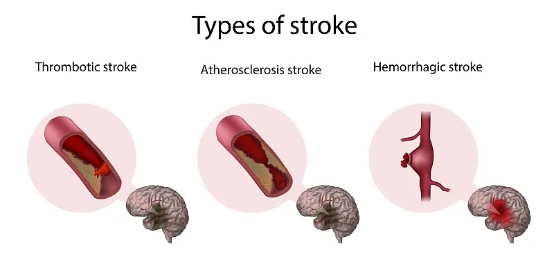 系統評估干細胞療法治療缺血性中風的安全性及可行性