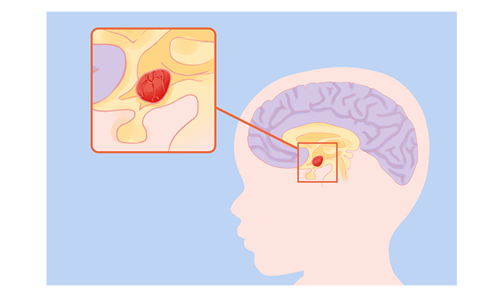 干細胞治療腦癱的成功率是多少? 干細胞治療腦癱的成功率是多少?