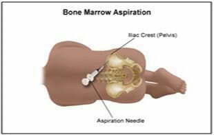 從骨髓中分離干細(xì)胞 從骨髓中分離干細(xì)胞