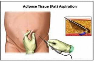 從脂肪中分離干細(xì)胞脂肪 從脂肪中分離干細(xì)胞脂肪