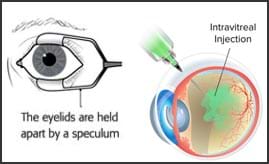 玻璃體內(nèi)輸注 玻璃體內(nèi)輸注