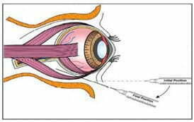 6. 細(xì)胞后小管輸注 6. 細(xì)胞后小管輸注