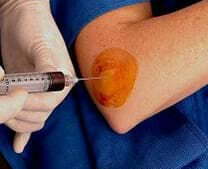 皮內(nèi)給藥 皮內(nèi)給藥