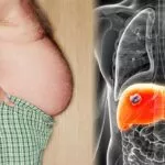 肝損傷警告信號——腹部腫脹 肝損傷警告信號——腹部腫脹