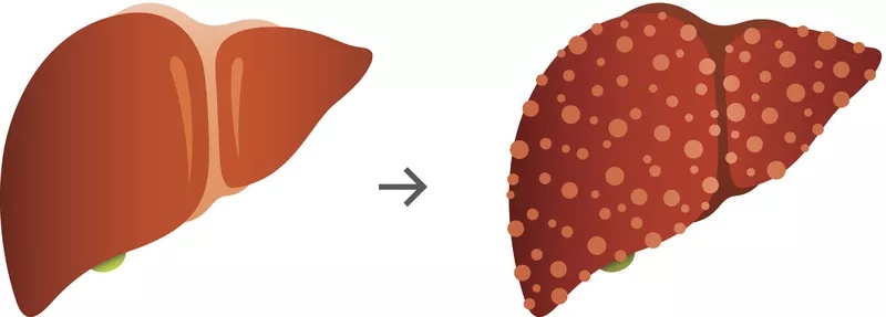 肝硬化的體征和癥狀是什么？及其治療方法