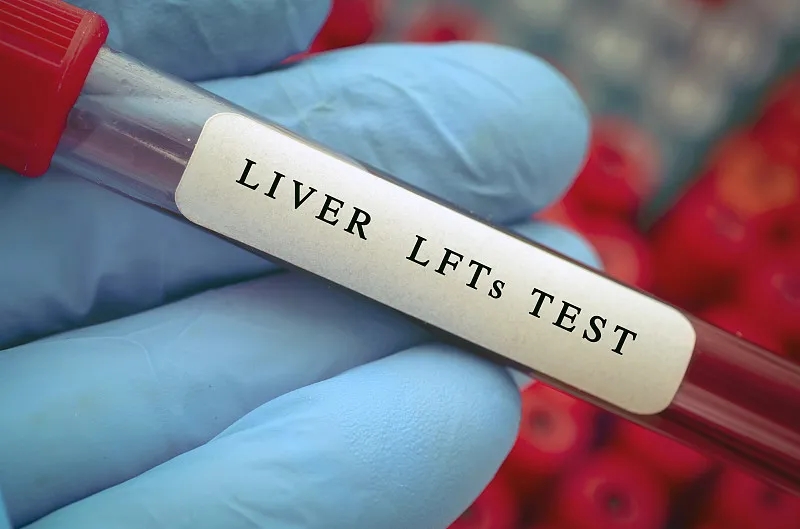 診斷酒精相關的肝病 診斷酒精相關的肝病