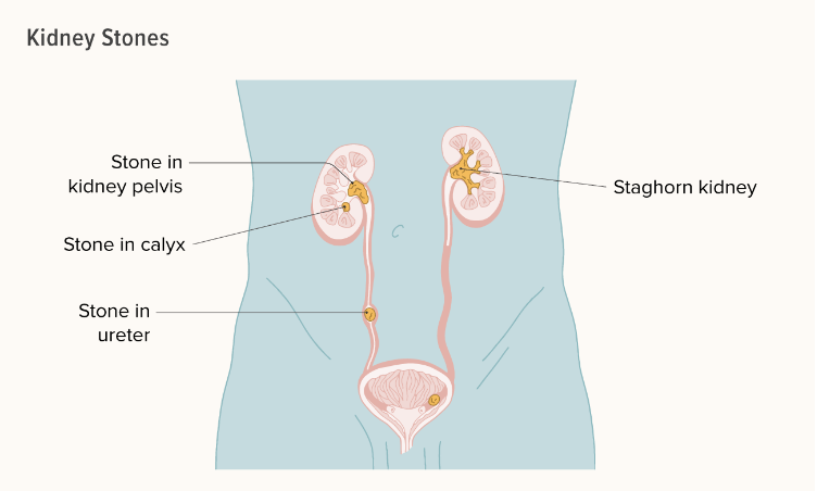 關于腎結石您需要知道的一切 關于腎結石您需要知道的一切
