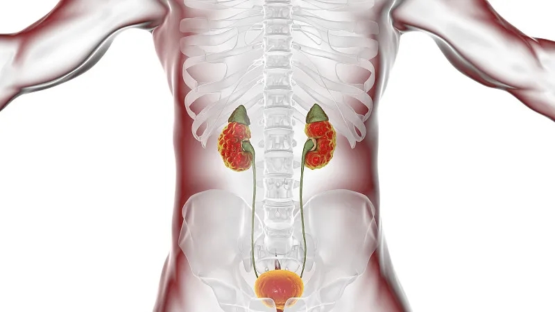 間充質干細胞治療狼瘡性腎炎的臨床研究進展 間充質干細胞治療狼瘡性腎炎的臨床研究進展