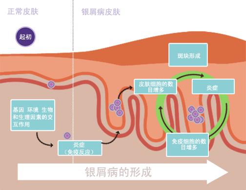 銀屑病治愈：是科學事實還是虛假希望？