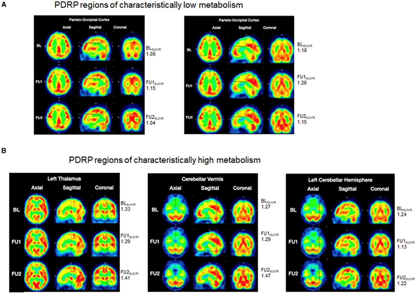 圖3:FDG-PET掃描 圖3:FDG-PET掃描