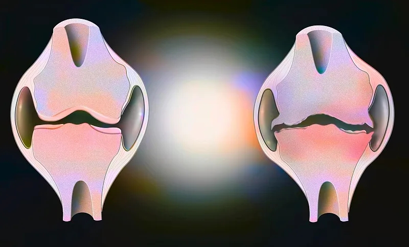 盤點:2020~2023年干細胞治療骨關節炎的臨床研究進展 盤點:2020~2023年干細胞治療骨關節炎的臨床研究進展