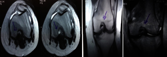 圖1:治療前MRI顯示內側和外側半月板后角的III級撕裂。 圖1:治療前MRI顯示內側和外側半月板后角的III級撕裂。