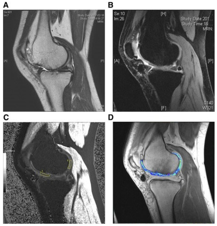 圖3:HUCB-MSC治療后3年軟骨再生的MRI評估 圖3:HUCB-MSC治療后3年軟骨再生的MRI評估