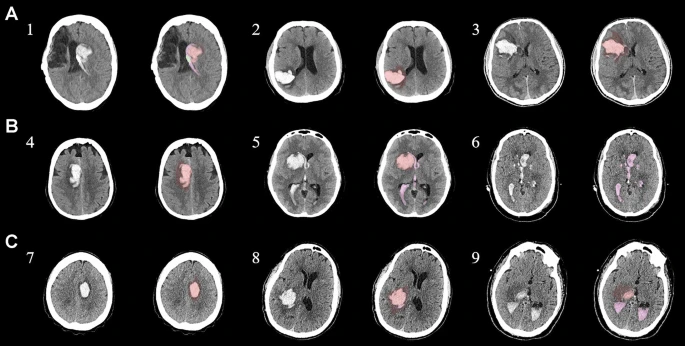 圖1:每個間充質干細胞治療患者按組的原始非對比計算機斷層掃描和分割結果 圖1:每個間充質干細胞治療患者按組的原始非對比計算機斷層掃描和分割結果