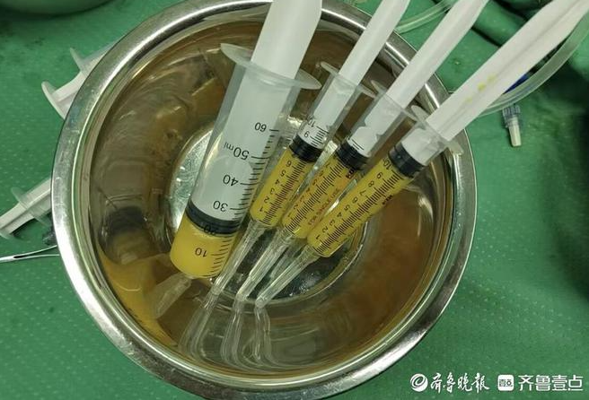 孫濤主任采用的自體脂肪微片段治療術,為她的治療帶來了新的轉機 孫濤主任采用的自體脂肪微片段治療術,為她的治療帶來了新的轉機