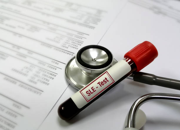 臍帶干細胞可以幫助狼瘡患者嗎? 臍帶干細胞可以幫助狼瘡患者嗎?