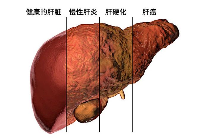 不同原因的肝損害發(fā)展主要分為三個階段:肝炎-肝硬化-肝癌。 不同原因的肝損害發(fā)展主要分為三個階段:肝炎-肝硬化-肝癌。