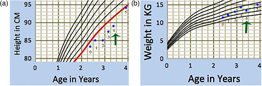 圖1:一名患有嚴(yán)重III型OI的男孩的生長曲線圖。 圖1:一名患有嚴(yán)重III型OI的男孩的生長曲線圖。