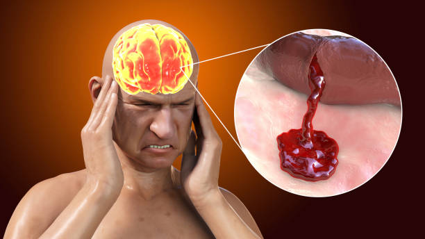 了解缺血性中風的病理生理學:當前療法的基礎和干細胞療法的機遇 了解缺血性中風的病理生理學:當前療法的基礎和干細胞療法的機遇