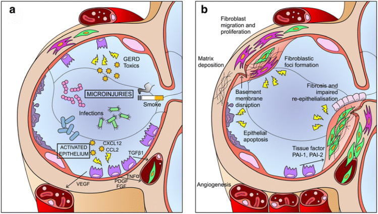圖1:IPF發(fā)病機(jī)制示意圖。 圖1:IPF發(fā)病機(jī)制示意圖。