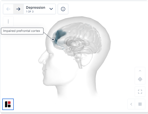 重度抑郁癥的特征 重度抑郁癥的特征