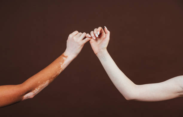 干細胞轉(zhuǎn)換醫(yī)學雜志:干細胞治療難治性白癜風安全有效 干細胞轉(zhuǎn)換醫(yī)學雜志:干細胞治療難治性白癜風安全有效