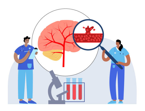 圍產期中風-類型、原因和風險因素 圍產期中風-類型、原因和風險因素