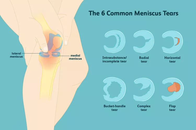 膝關(guān)節(jié)半月板損傷：你了解這六種撕裂類(lèi)型嗎？