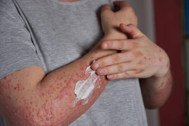 銀屑病的4類治療方式和用藥類型,你都清楚嗎? 銀屑病的4類治療方式和用藥類型,你都清楚嗎?