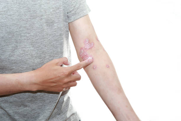 預(yù)防銀屑病發(fā)作的10個(gè)技巧,你都了解嗎? 預(yù)防銀屑病發(fā)作的10個(gè)技巧,你都了解嗎?