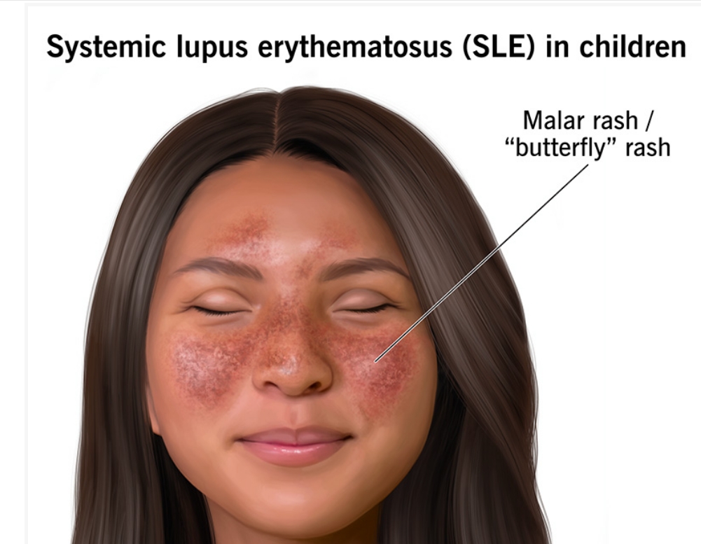 什么是兒童系統性紅斑狼瘡?及其病因和治療方法 什么是兒童系統性紅斑狼瘡?及其病因和治療方法