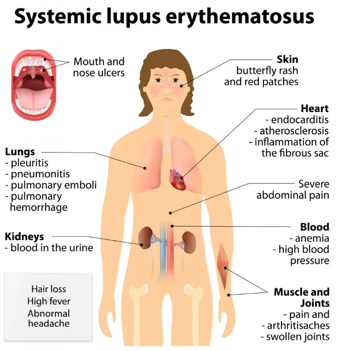 什么是系統(tǒng)性紅斑狼瘡?干細胞治療系統(tǒng)性紅斑狼瘡的臨床案例有哪些? 什么是系統(tǒng)性紅斑狼瘡?干細胞治療系統(tǒng)性紅斑狼瘡的臨床案例有哪些?